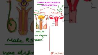 Surgical Contraception Vasectomy vs Tubectomy [upl. by Nathanoj]