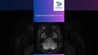 Superficial HemosiderosisSuperficialHemosiderosisNeuroRadiologyMRIImaging SusceptibilityMRI [upl. by Boorer]