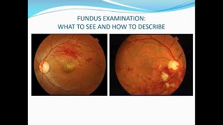 Fundus examination Volk lens direct ophthalmoscopy and binocular indirect ophthalmoscopy [upl. by Mapes]