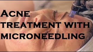 Acne treatment with microneedling [upl. by Nelie37]