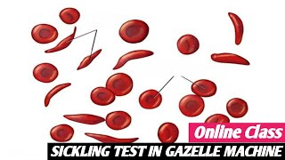 SICKLING TEST IN GAZELLE MACHINE ONLINE CLASS  Medical Science Education [upl. by Melentha472]