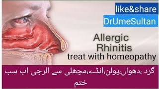 Allergic Rhinitis homeo medicine dust allergic pollen allergy tips and tricks vlogs pakistani [upl. by Bandur]