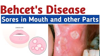 Behcets Disease  Symptoms Causes And Mouth sores treatment  how to get rid of mouth blisters [upl. by Yantruoc818]