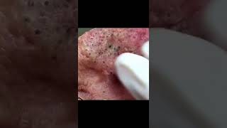 Who needs a Mr Wilson break 🙋🏻‍♀️ drpimplepopper [upl. by Nappie]