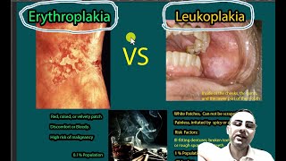 Erythroplakia Vs Leukoplakia Symptoms causes risk of malignancies [upl. by Janessa939]