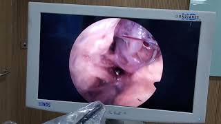 Endoscopic Transorbital Approach [upl. by Trepur]