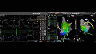 Confidense Automatic Mapping Left Accessory Pathway Manifest [upl. by Clinton628]