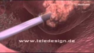 HNO 017 NasenPolypen Entfernung  PAL 169 HNO 017 Removal of nasal polyps  PAL 169 [upl. by Tansey]