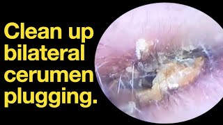 Clean up bilateral cerumen plugging ear wax removal  ear cleaning  ASMR  relaxation  relax [upl. by Fishback789]