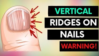 Warning Vertical Ridges on Your Nails [upl. by Cad]