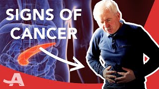 Early Signs of Pancreatic Cancer [upl. by Luar499]