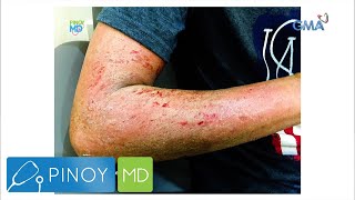 Pinoy MD Effective ways to treat the atopic dermatitis [upl. by Glimp570]