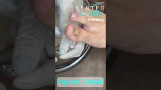 Ingrown Toenail κεντροποδιου kentropodiou podiatry podiatria podologia podology podiatrist [upl. by Eentroc]