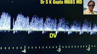 Ductus Venosus Flow Waves explained First Trimester Pregnancy Ultrasound [upl. by Nomae]