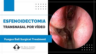 Esfenoidectomia Transnasal por Vídeo Endoscopia Sphenoid Fungus Ball Surgical Treatment  FESS [upl. by Enalahs]