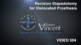 Revision Stapedotomy for Dislocated Stapes Prosthesis Teflon Piston [upl. by Therron301]