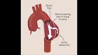 Aortic Dissection [upl. by Firman]