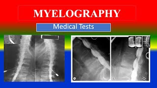 MYELOGRAPHY  Medical Tests  What is   Uses  Need  Preparation  Results [upl. by Lough682]