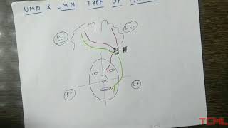 Upper and lower motor neuron type of facial palsy [upl. by Malony274]