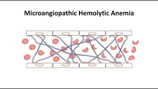 Microangiopathic Hemolytic Anemia [upl. by Renrag]