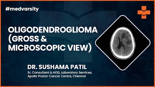 Oligodendroglioma Gross amp Microscopic View  MedvarsityOnlineLtd [upl. by Nitsir778]