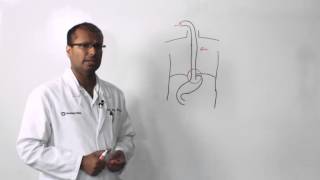 Esophageal Cancer [upl. by Akerehs]