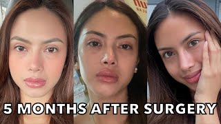 Upper Blepharoplasty amp Rhinoplasty Update 5 months after [upl. by Theone883]