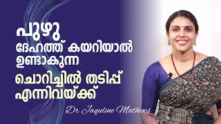 പുഴു ദേഹത്ത് കയറിയാൽ  വീട്ടിൽ ചെയ്യാവുന്ന പൊടിക്കൈകൾ  Dr Jaquline Mathews BAMS [upl. by Suravart903]