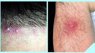 Folliculitis quick review folliculitis diagnosis and treatment [upl. by Yeblehs]