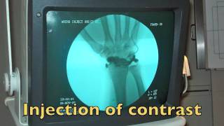 Wrist Arthrogram [upl. by Innoj]