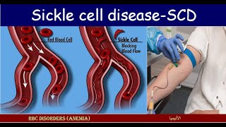 Lecture 282 Sickle Cell Disease  SCD [upl. by Bobbye]