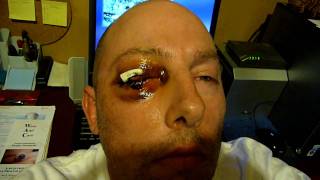 3 Days After My Eye Removal Surgery ENUCLEATION [upl. by Vona248]