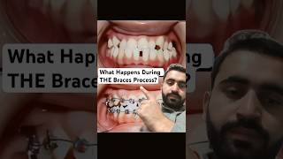 What Happens During THE Braces Processbraces dentist orthodontist dentistry bracesadjustment [upl. by Elfont273]