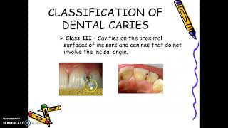 Lecture Day 2 Review of Cariology [upl. by Creamer122]