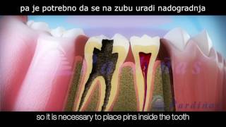 endodoncija  postupak lecenja zuba [upl. by Potter]