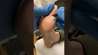 Watch Podiatrist Debride Wart After Salicylic Acid Treatment  Hard Skin Removal with Docpods [upl. by Shishko31]