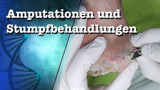 Amputationen und Stumpfbehandlung podologinandrea [upl. by Aldwin]