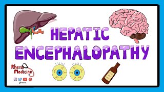 Hepatic Encephalopathy  Pathophysiology Stages and West Haven Criteria [upl. by Jacklyn]