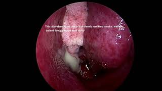 Left sided chronic maxillary sinusitis with pus [upl. by Joann761]