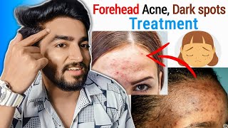 Forehead Acne Pimples Blackheads and Darkspots Treatment [upl. by Hannon330]