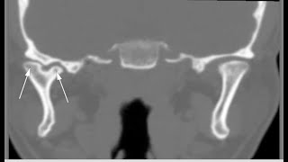 Radiology MSK Variants radiopediactxrayultrasoundtipstricksexams [upl. by Sammons861]