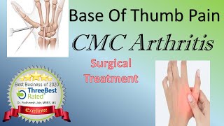 Surgical management of First CMC Arthritis [upl. by Giulio642]