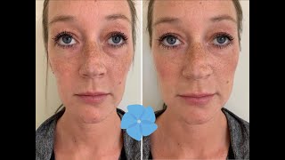 Juvederm Voluma Cheek Filler Treatment  Before  After  Nashville PA [upl. by Nnylacissej]