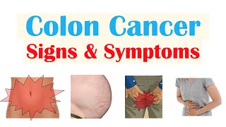 Colon Cancer CRC Signs amp Symptoms amp Why They Occur [upl. by Naihtsirc]