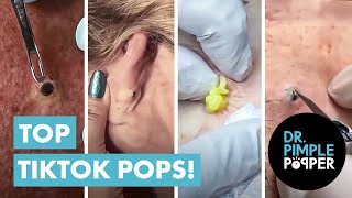 Dr Pimple Popper’s Top 10 Tiktok Pops [upl. by Annavoig404]