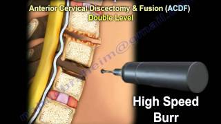 Cervical Spine Decompression And Fusion   Everything You Need To Know  Dr Nabil Ebraheim [upl. by Darken]