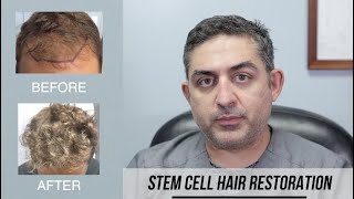 Stem Cell Hair Restoration Success Story [upl. by Kenrick656]