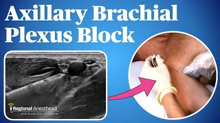 Axillary Brachial Plexus Block [upl. by Truitt]