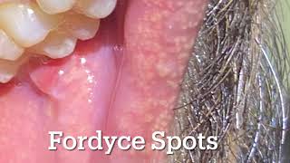 Fordyce Spots white yellow bumps over lips and cheek Should I worry [upl. by Cida]