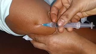 IM Intramuscular Arm injection Push Ketorolac  Xerokit  injection Ep 34 Injection Vision [upl. by Acirej]